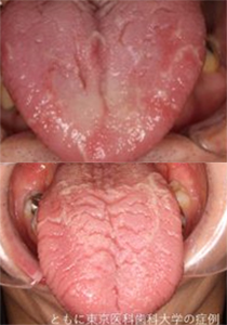 舌痛症は何科で受診すべきか ラクシア銀座歯科クリニック